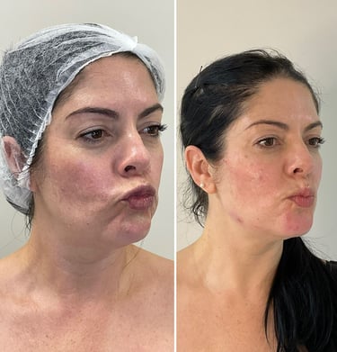 Rejuvenescimento Avançado
