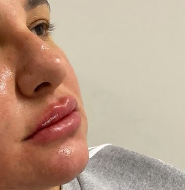 Preenchimento Labial